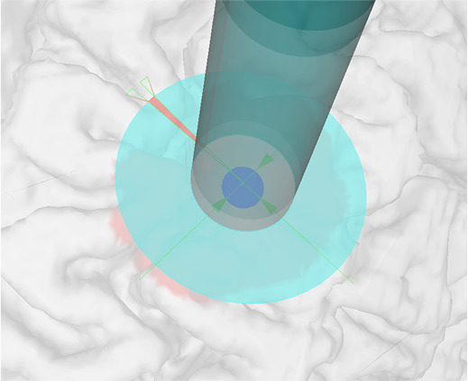 Guided TMS Neuronavigation