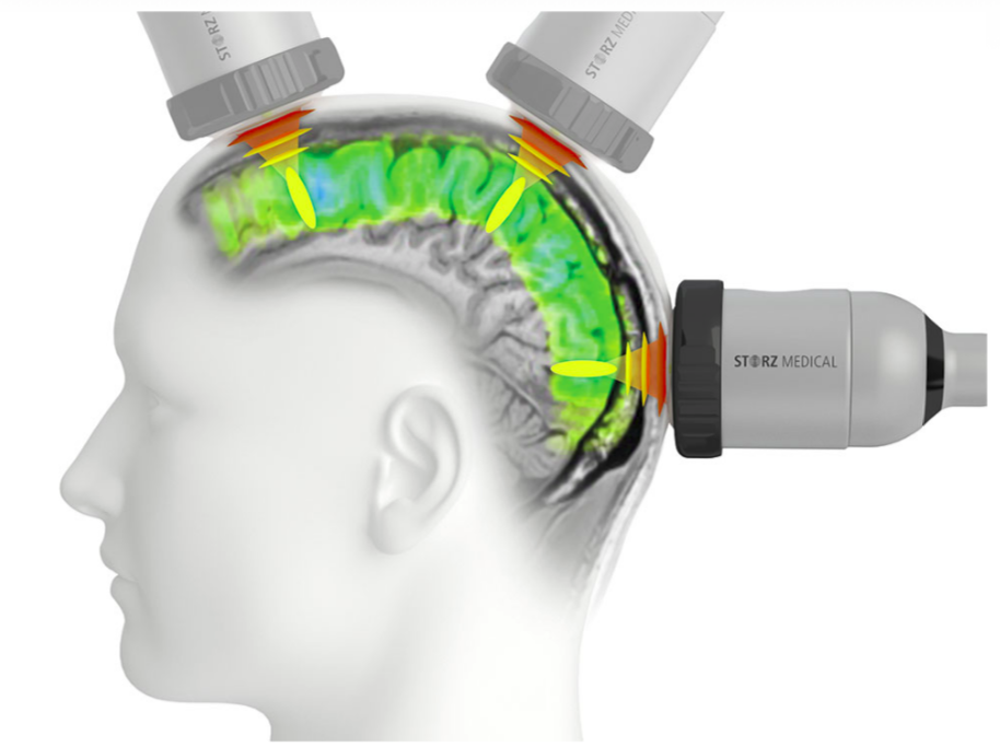 Soterix Medical Transcranial Pulse Stimulation (TPS) Webinar