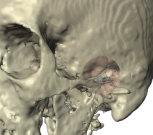 Clinical and Research Standard for Vestibular Stimulation