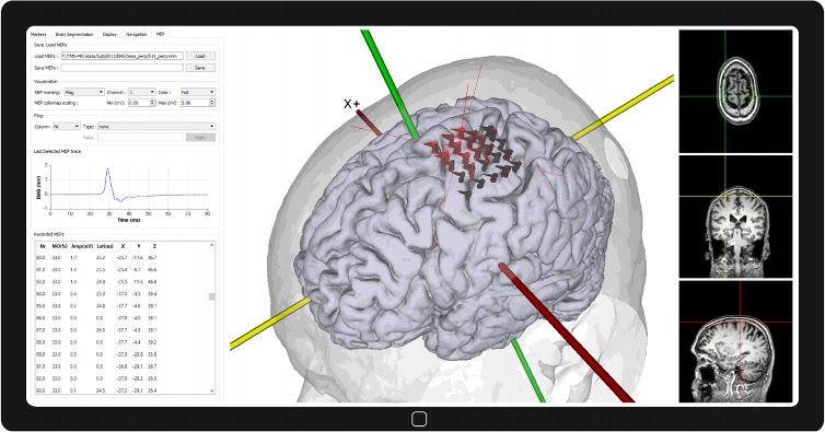 Soterix Medical ElectraRx Webinar