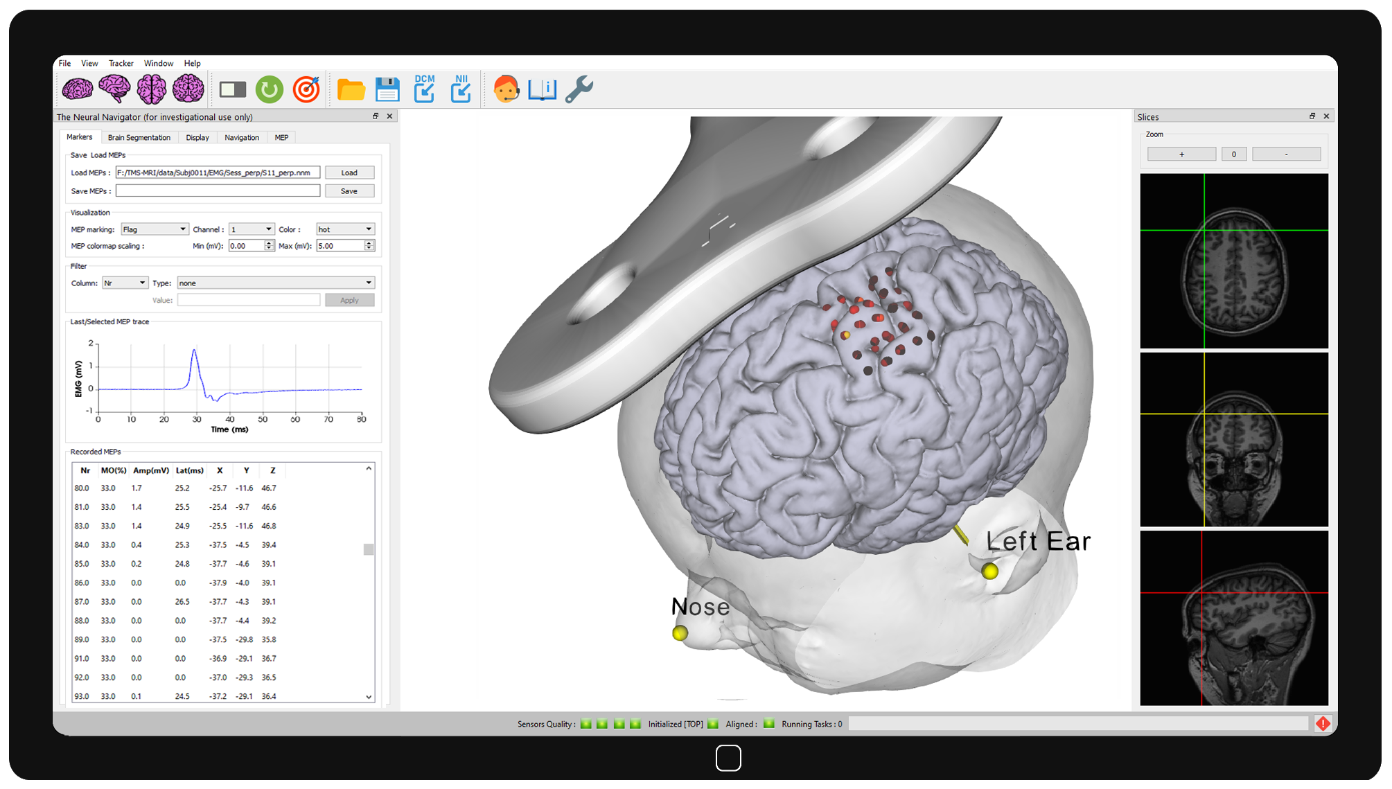 Neuronavigation New Targeting Approach